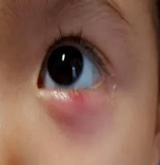 去眼袋手术