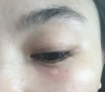 去眼袋手术