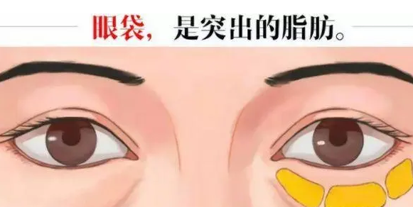 去眼袋手术