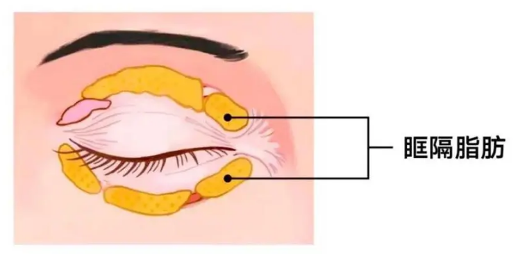 去眼袋手术