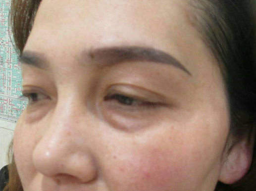 去眼袋手术