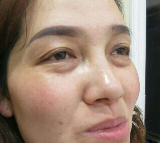 去眼袋手术