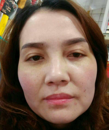 去眼袋手术