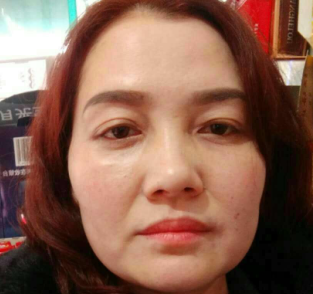去眼袋手术