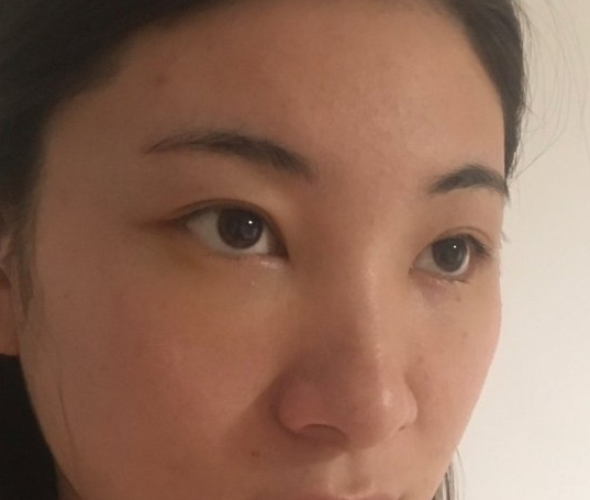 去眼袋手术