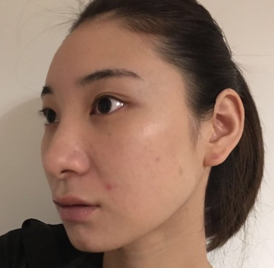 去眼袋手术