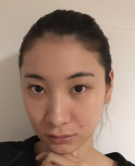去眼袋手术