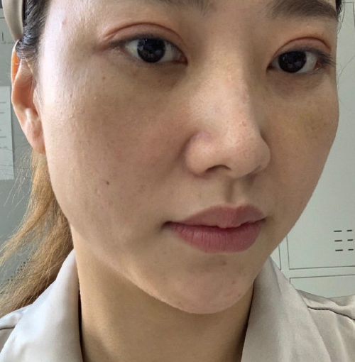 去眼袋手术