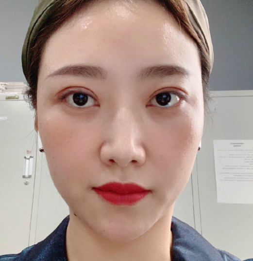 去眼袋手术