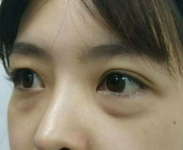 去眼袋手术