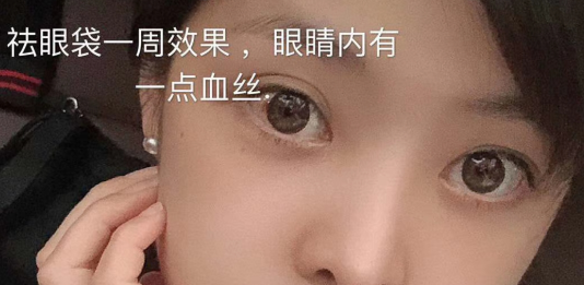 去眼袋手术