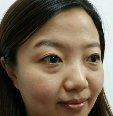 去眼袋手术