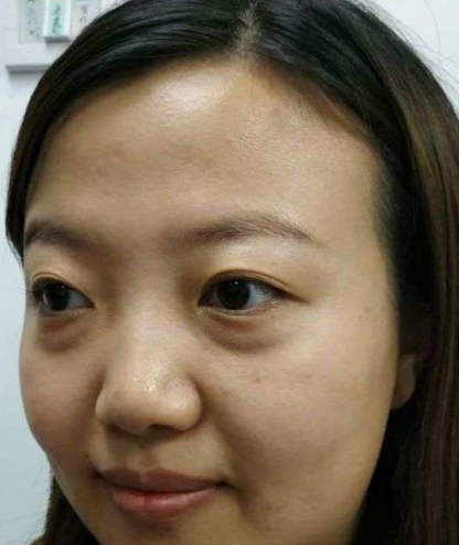 去眼袋手术