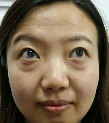 去眼袋手术