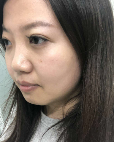 去眼袋手术