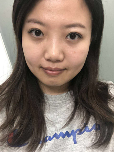 去眼袋手术