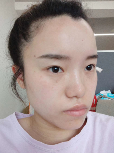 去眼袋手术