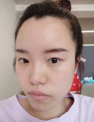 去眼袋手术