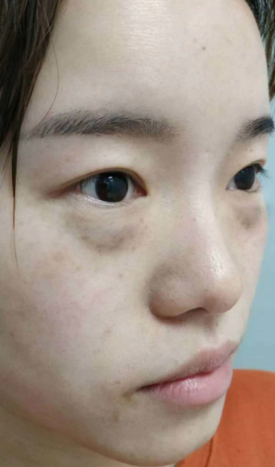 去眼袋手术