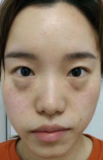 去眼袋手术