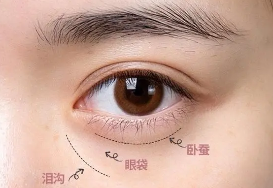 去眼袋手术