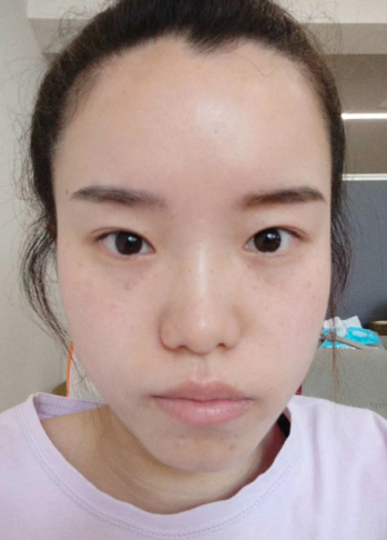 去眼袋手术