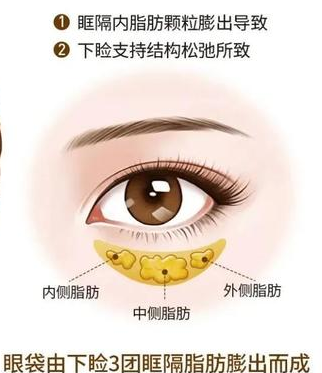 去眼袋手术