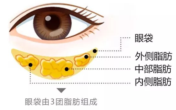 去眼袋手术