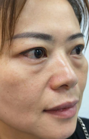 去眼袋手术
