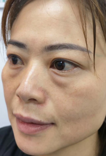 去眼袋手术