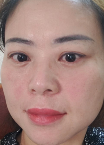 去眼袋手术