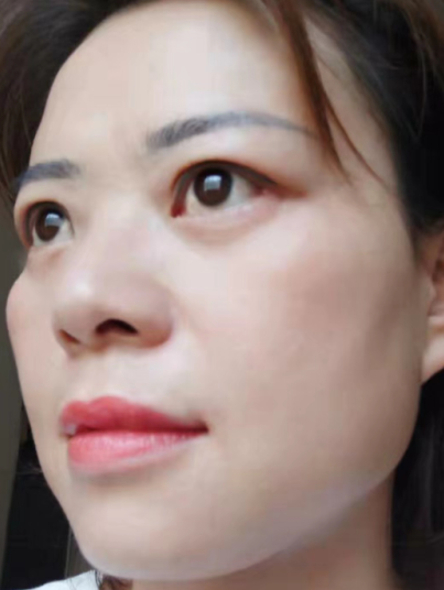 去眼袋手术