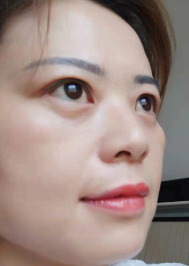 去眼袋手术