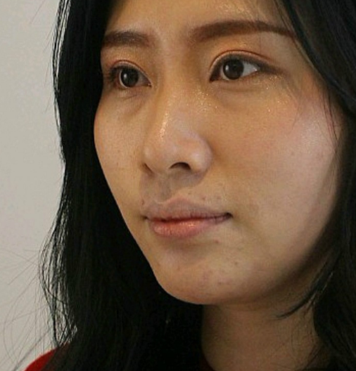 超雅不开刀按摩去眼袋需要休假恢复吗?631 超雅不开刀按摩去眼袋需要休假恢复吗?631