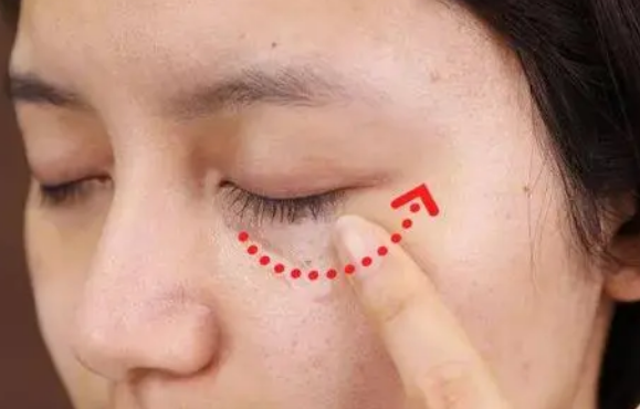 去眼袋手术
