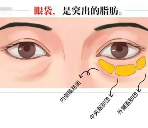 去眼袋手术