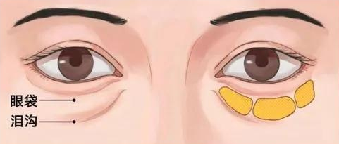 去眼袋手术