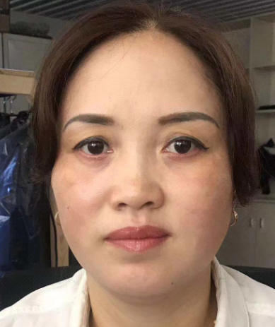 去眼袋手术
