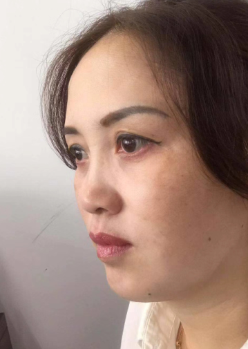 去眼袋手术