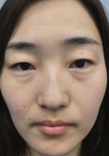 去眼袋手术