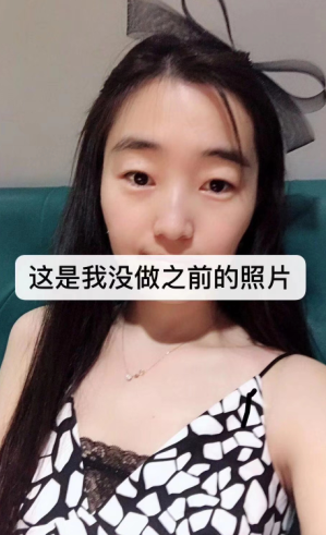 去眼袋手术