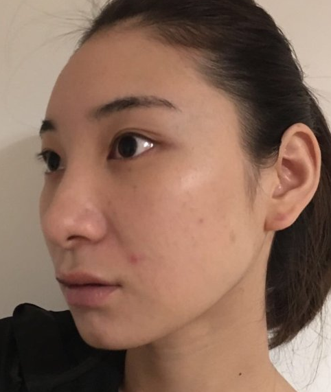 去眼袋手术