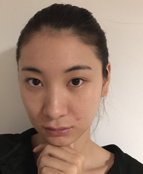 去眼袋手术