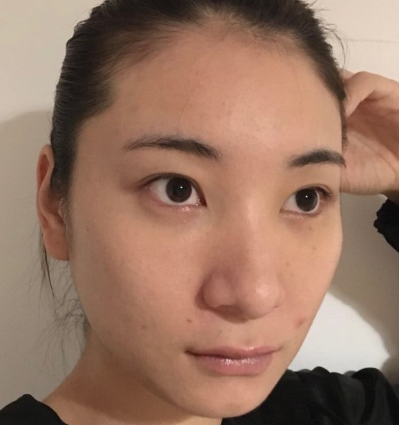 去眼袋手术