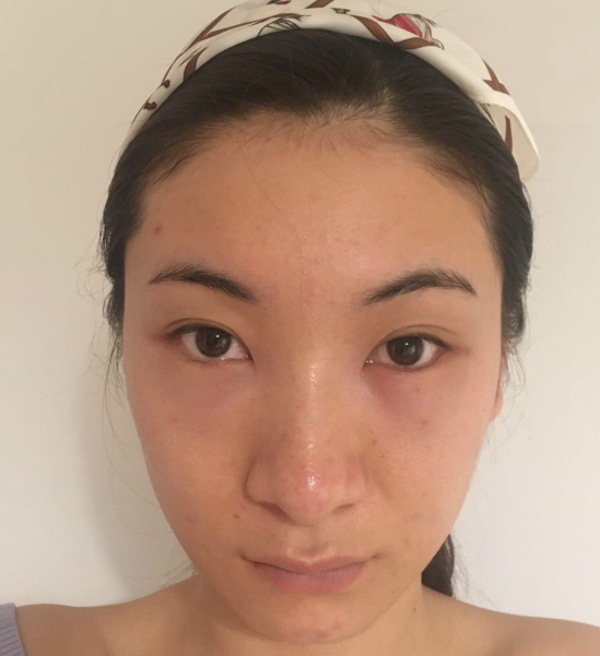 去眼袋手术