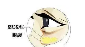 去眼袋手术