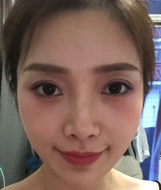 去眼袋手术
