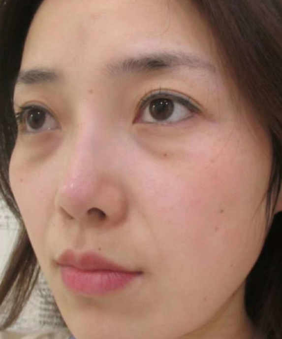 去眼袋手术