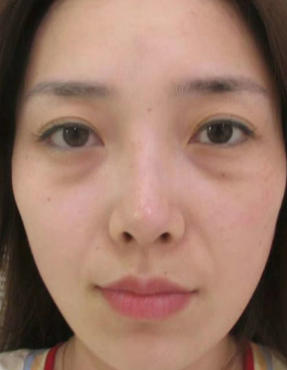 去眼袋手术