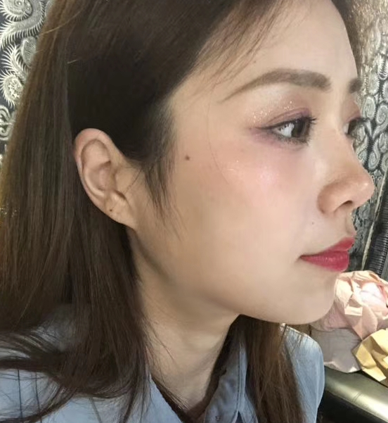 去眼袋手术